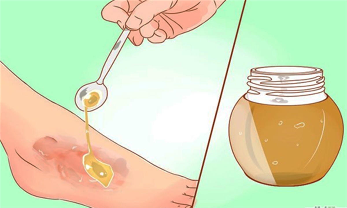 درمان زخم ها با عسل