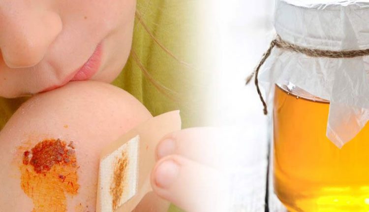 درمان انواع زخم ها با عسل